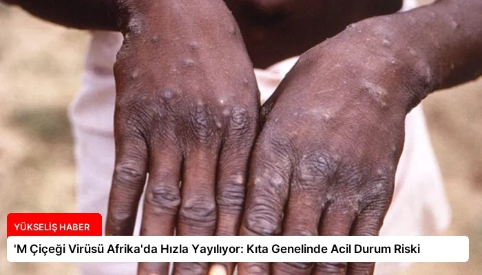 ‘M Çiçeği Virüsü Afrika’da Hızla Yayılıyor: Kıta Genelinde Acil Durum Riski
